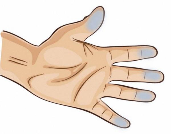 Онемение в кончиках пальцев при нарушении кровообращения