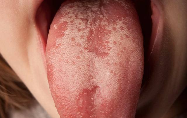 Вид языка при воспалении по типу глоссита