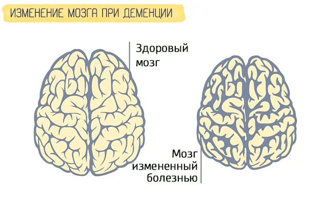 Структурные изменения в головном мозге при деменции