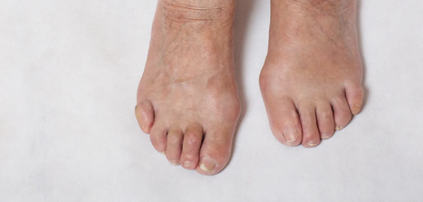 Пример развития подагры на пальцах ног