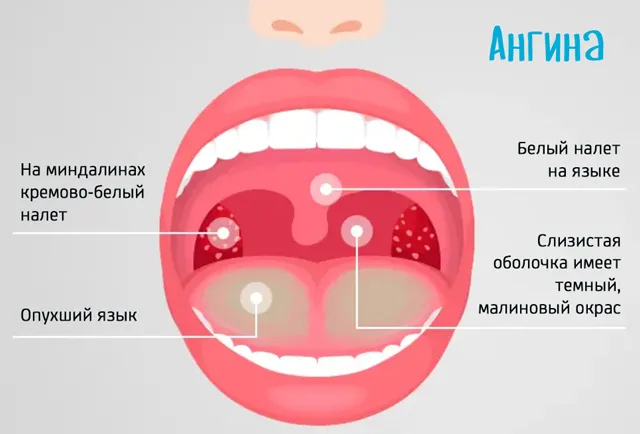Главные отличия ангины в горле
