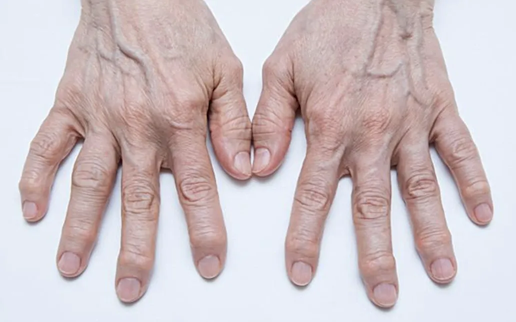 Ревматоидный артрит на суставах рук пожилого человека