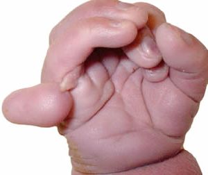 Лишний палец на руке младенца с синдромом Патау