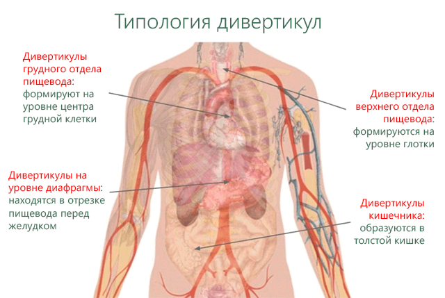 Локализация различных типов дивертикул в желудочно-кишечном тракте
