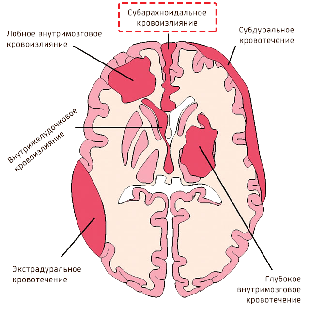Типы внутримозговых кровотечений