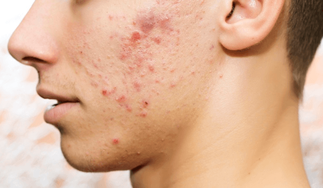 Бактериальная сыпь на лице подростка