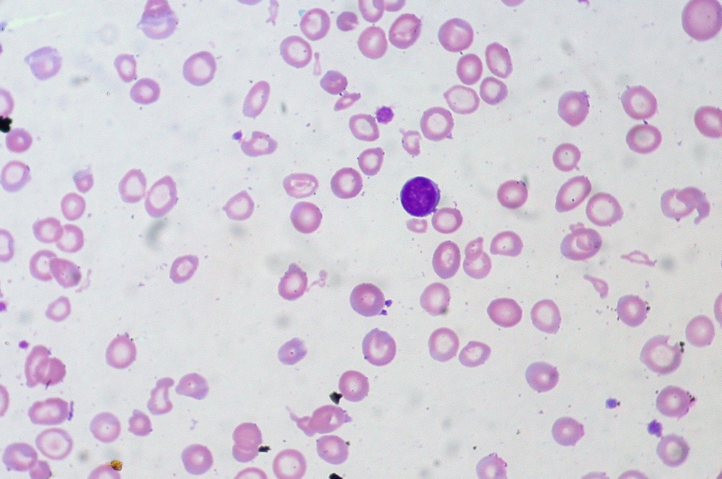 Железодефицитная анемия в мазке крови