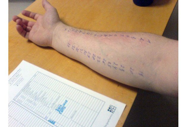 Кожные аллергические тесты помогают в диагностике сложных аллергий