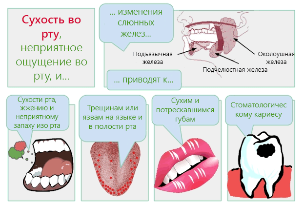 Как проявляется ксеростомия (сухость полости рта)