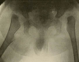 Рентгеновский снимок вывиха тазобедренного сустава