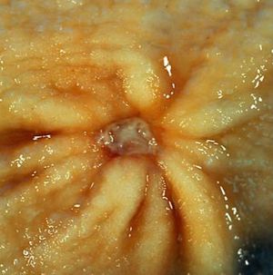 Вид язвы желудка при гастроскопии