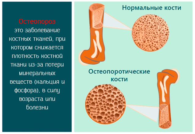 Остеопороз – это заболевание костей при котором снижается плотность костной ткани