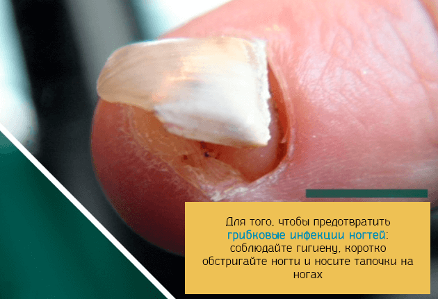 Разрушение ногтевой пластины при заражении грибком