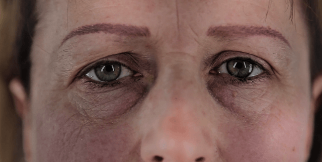 Мимические морщинки вокруг глаз женщины