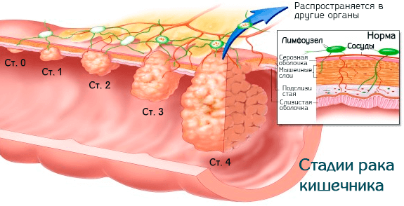 Стадии развития рака кишечника и переход в другие органы
