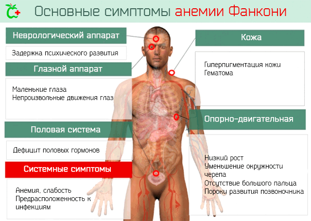 Основные симптомы анемии Фанкони