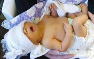 Желтушная кожа ребенка с повышенным уровнем билирубина